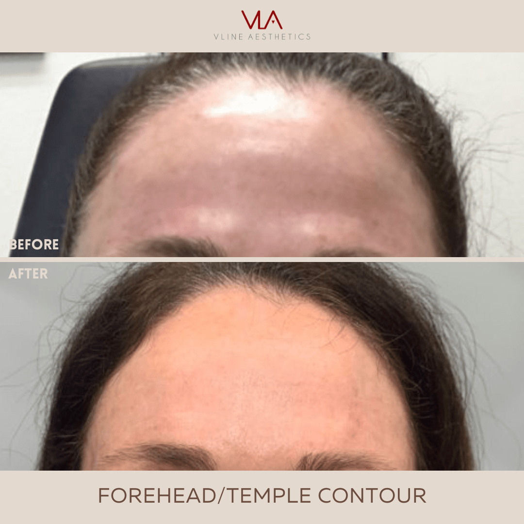 3D Forehead Contour - Skin Perfect Brothers Powered by VLA