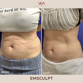 EMSculpt NEO  - 1 Session - Skin Perfect Brothers Powered by VLA