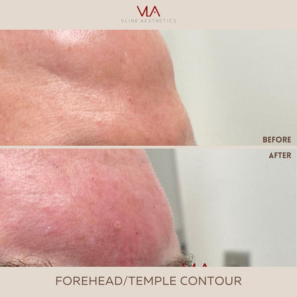 3D Forehead Contour - Skin Perfect Brothers Powered by VLA