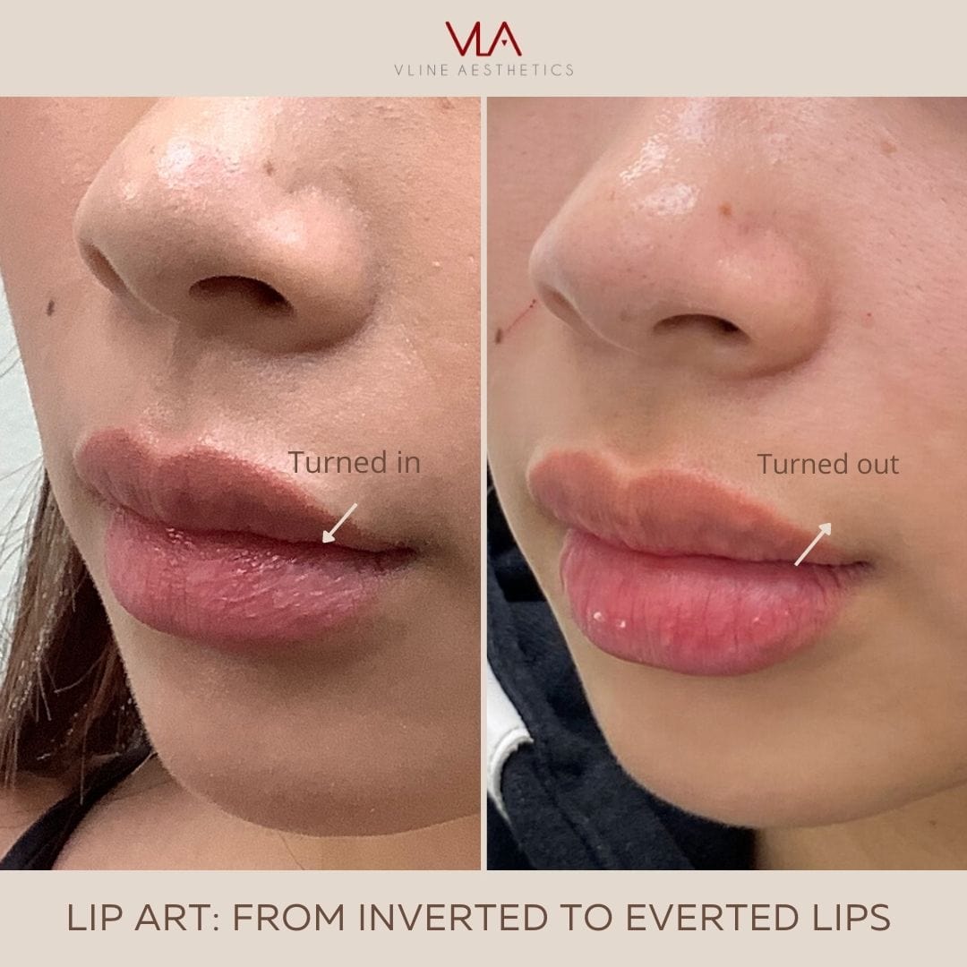 Lip Art - Skin Perfect Brothers Powered by VLA