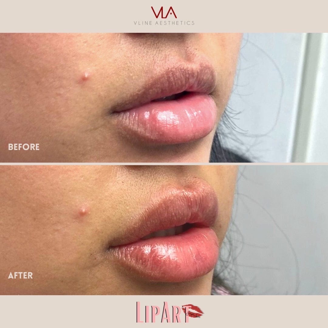 Lip Art - Skin Perfect Brothers Powered by VLA