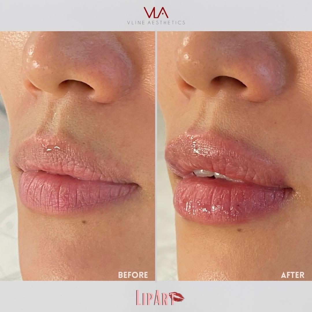 Lip Art - Skin Perfect Brothers Powered by VLA