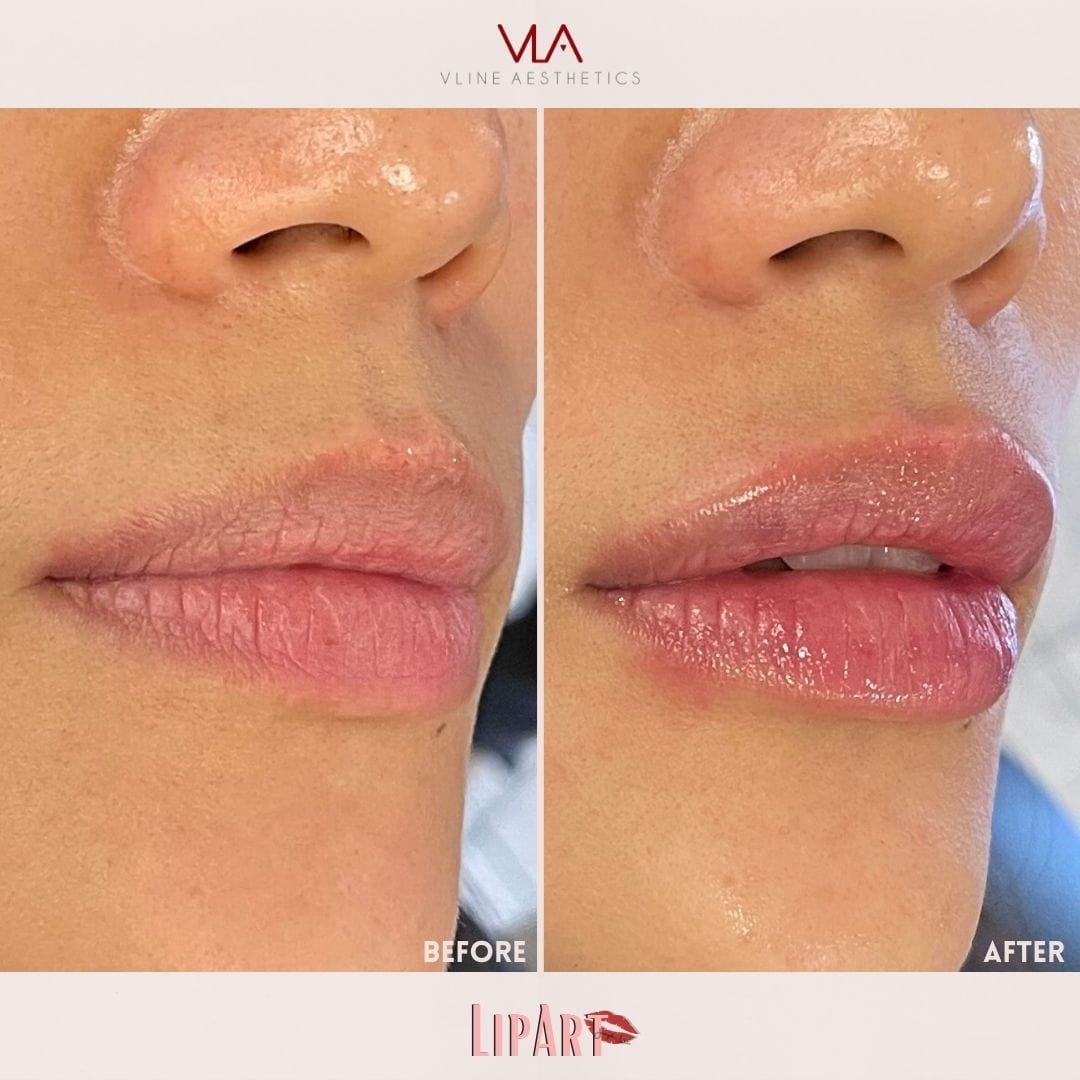Lip Art - Skin Perfect Brothers Powered by VLA