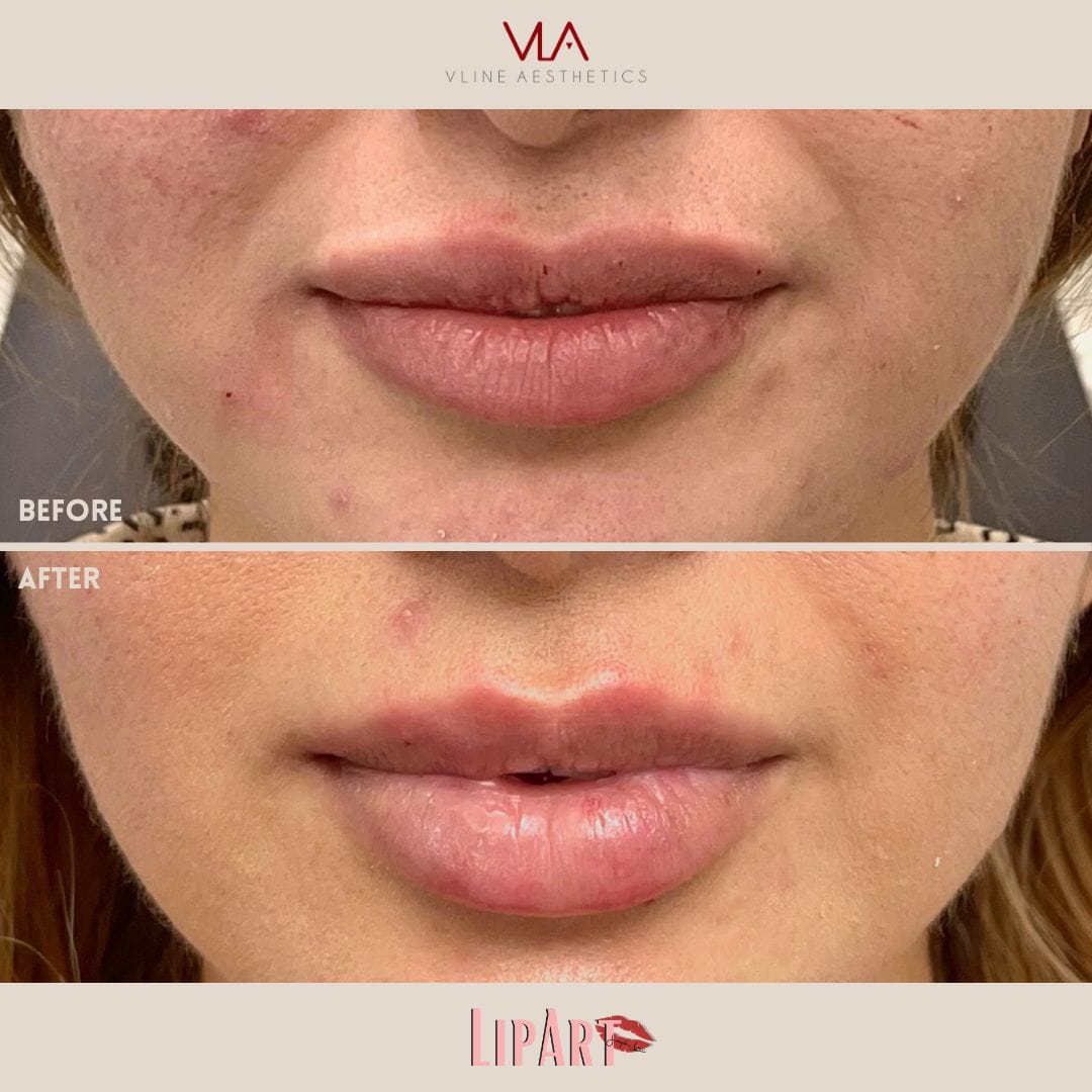 Lip Art - Skin Perfect Brothers Powered by VLA