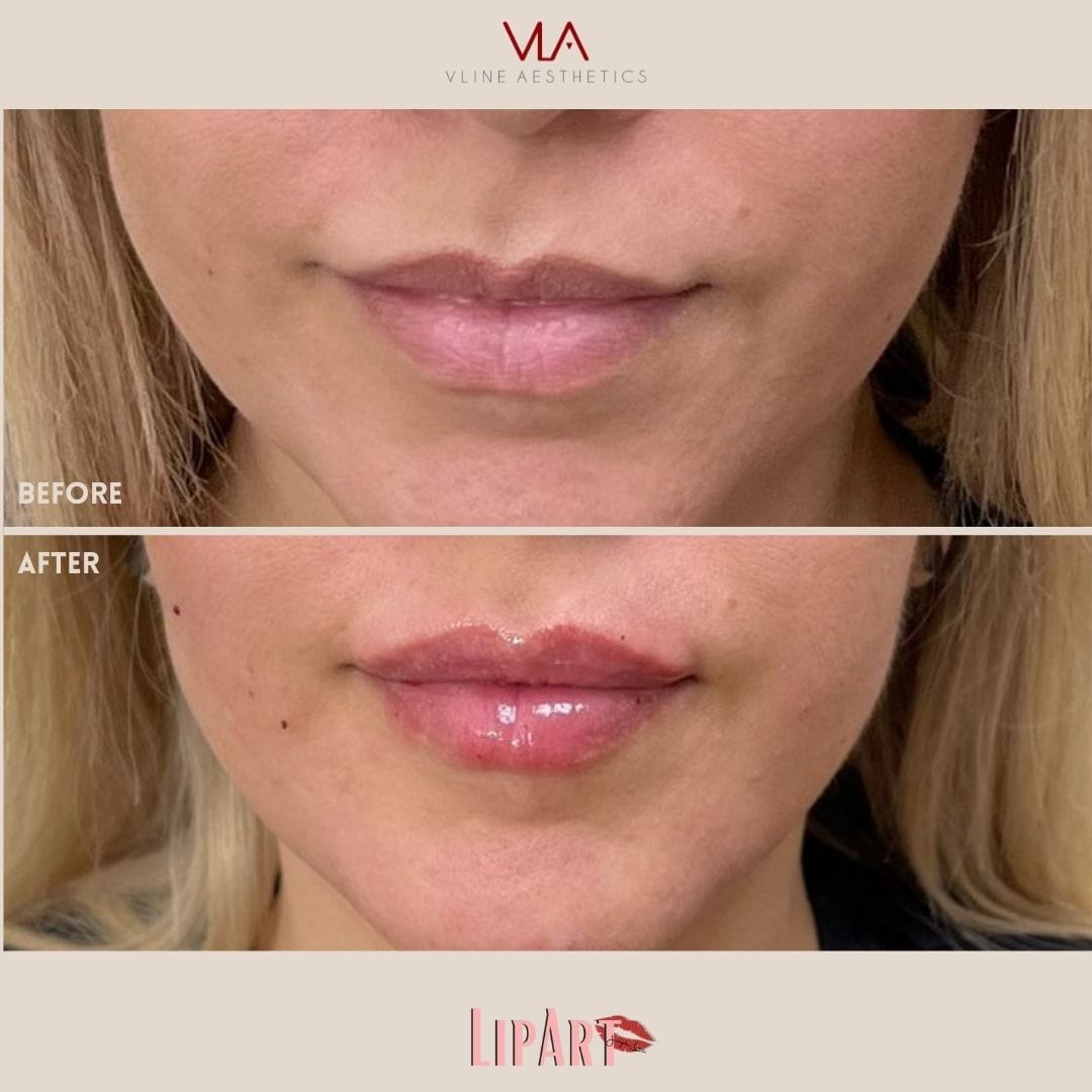 Lip Art - Skin Perfect Brothers Powered by VLA