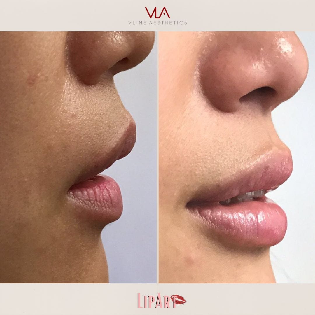 Lip Art - Skin Perfect Brothers Powered by VLA