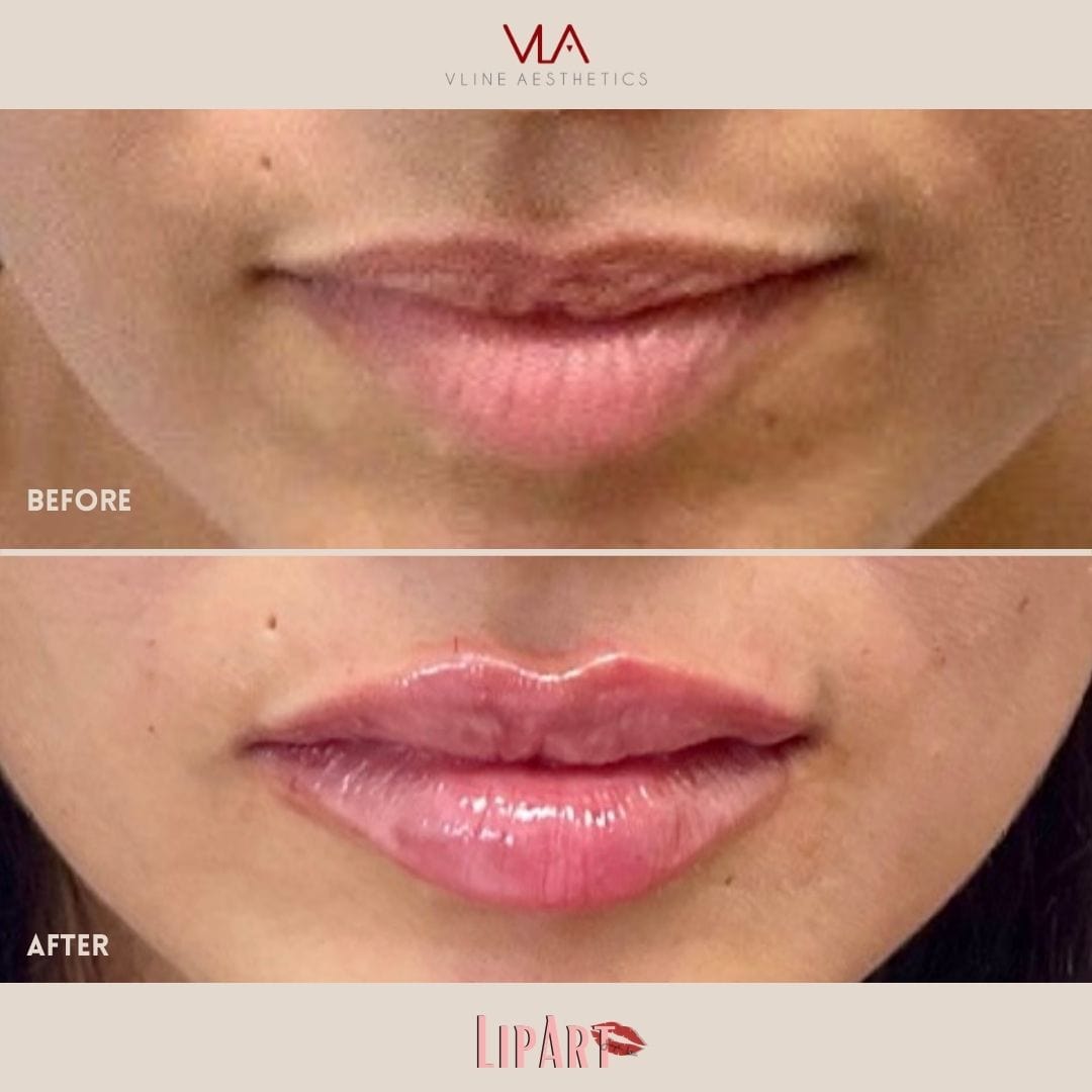 Lip Art - Skin Perfect Brothers Powered by VLA
