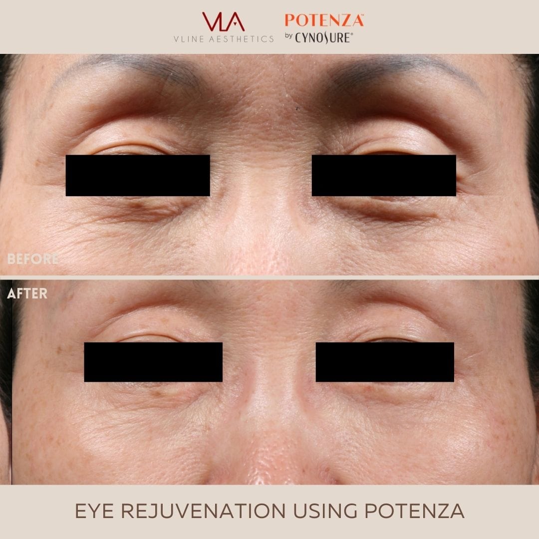 Potenza | RF Microneedling - Skin Perfect Brothers Powered by VLA