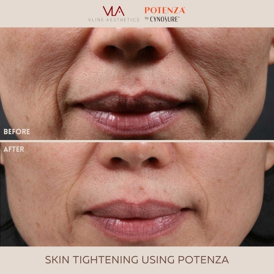 Potenza | RF Microneedling - Skin Perfect Brothers Powered by VLA