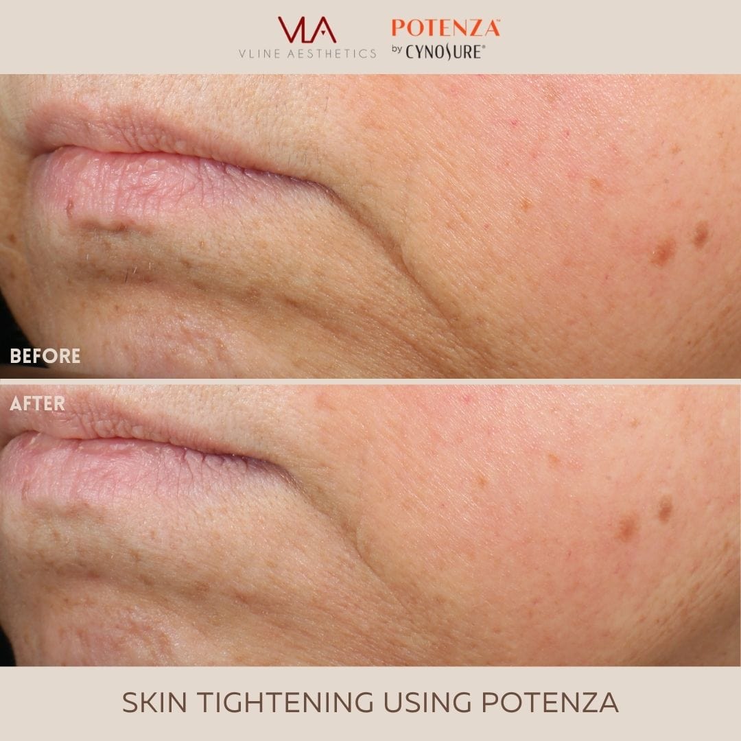 Potenza | RF Microneedling - Skin Perfect Brothers Powered by VLA