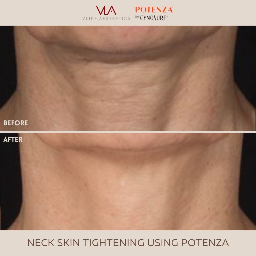 Potenza | RF Microneedling - Skin Perfect Brothers Powered by VLA
