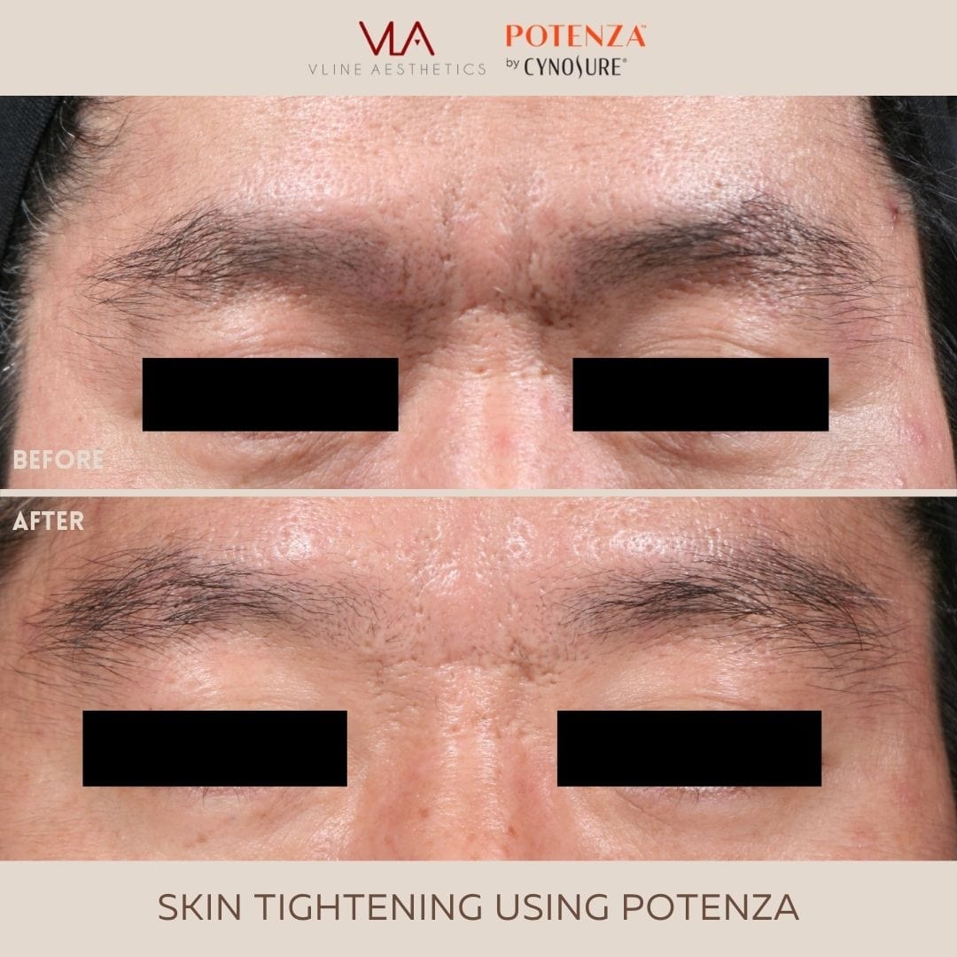 Potenza | RF Microneedling - Skin Perfect Brothers Powered by VLA