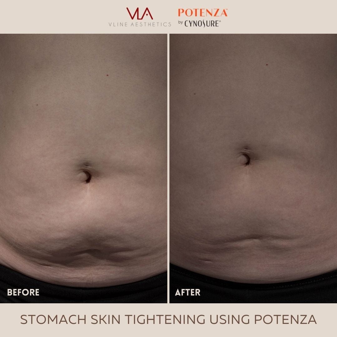 Potenza | RF Microneedling - Skin Perfect Brothers Powered by VLA