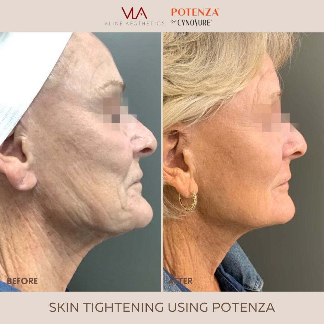 Potenza | RF Microneedling - Skin Perfect Brothers Powered by VLA