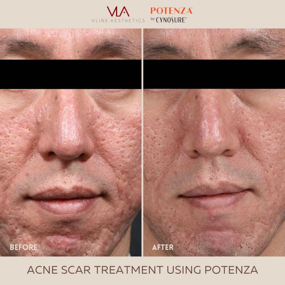 Potenza | RF Microneedling - Skin Perfect Brothers Powered by VLA