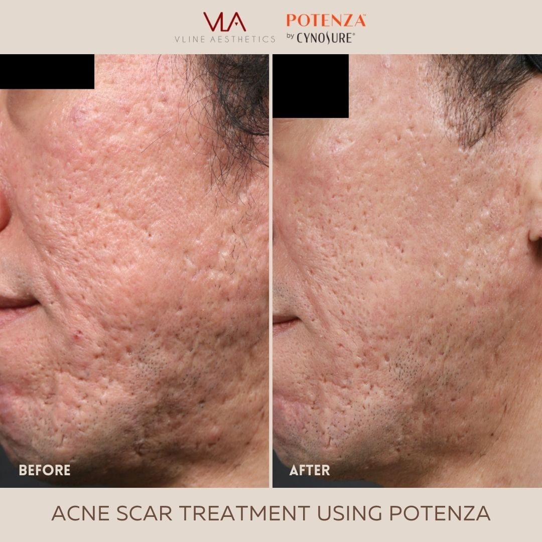 Potenza | RF Microneedling - Skin Perfect Brothers Powered by VLA