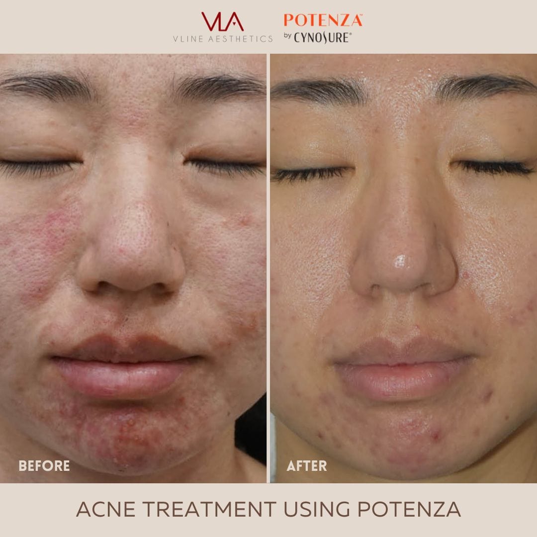 Potenza | RF Microneedling - Skin Perfect Brothers Powered by VLA