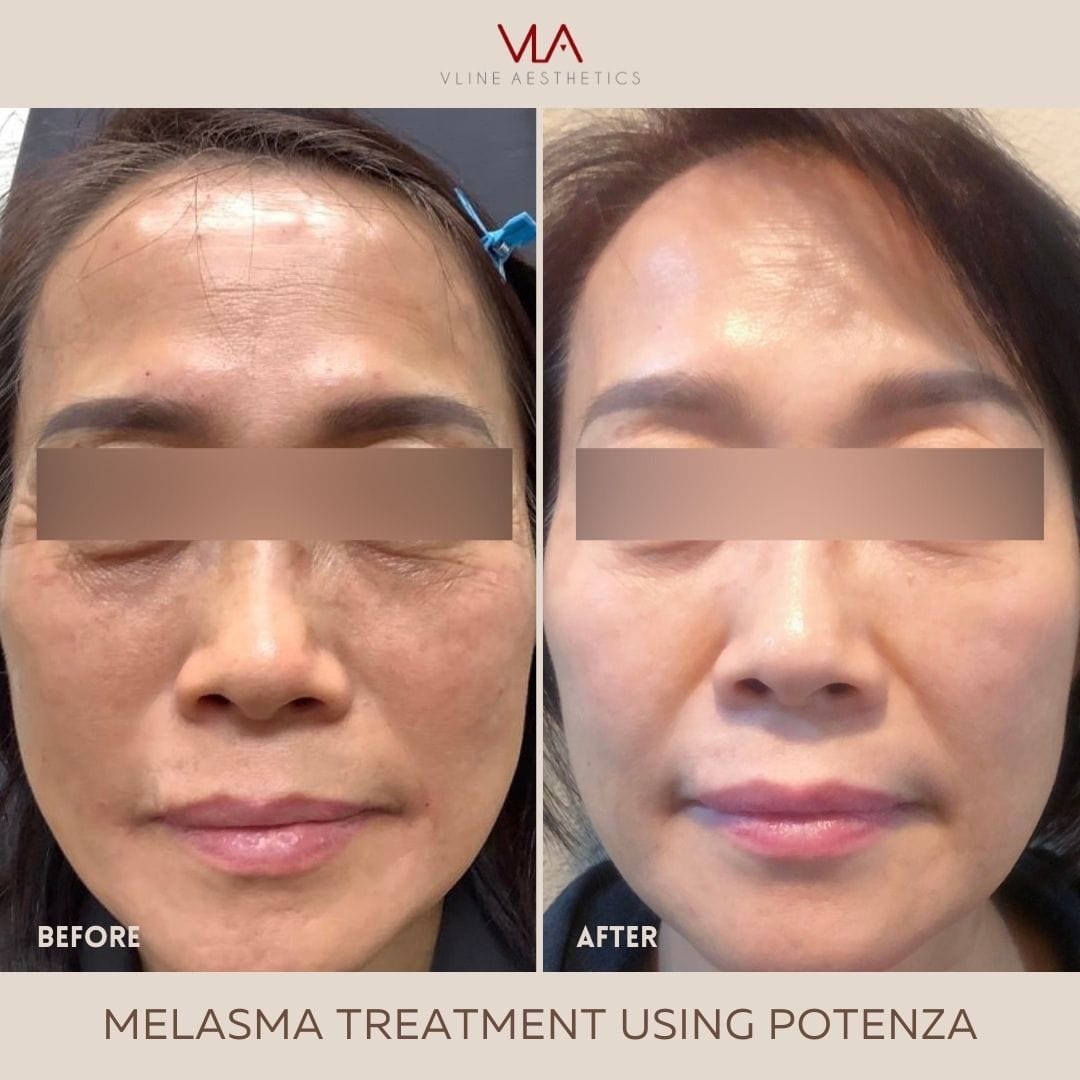 Potenza | RF Microneedling - Skin Perfect Brothers Powered by VLA