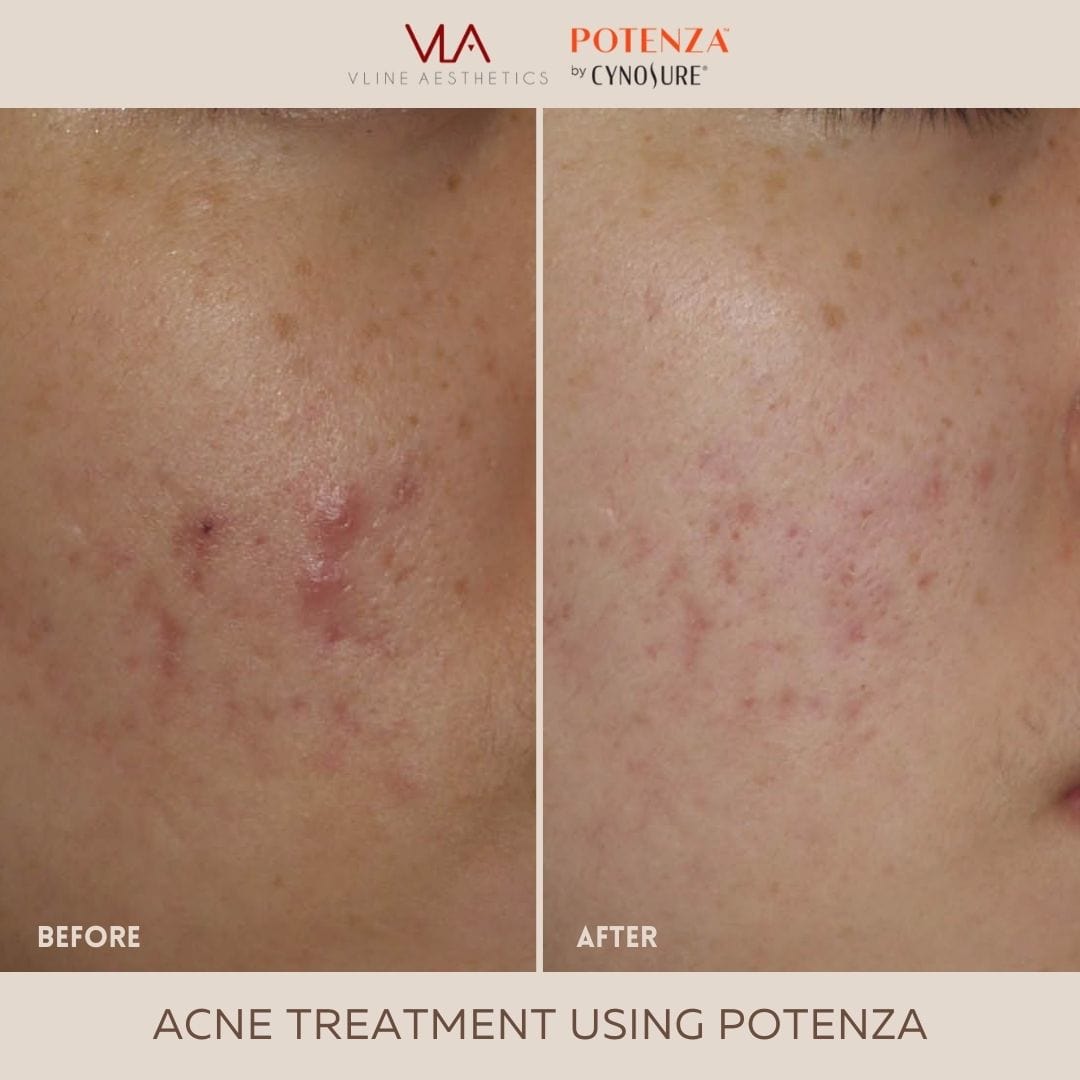 Potenza | RF Microneedling - Skin Perfect Brothers Powered by VLA