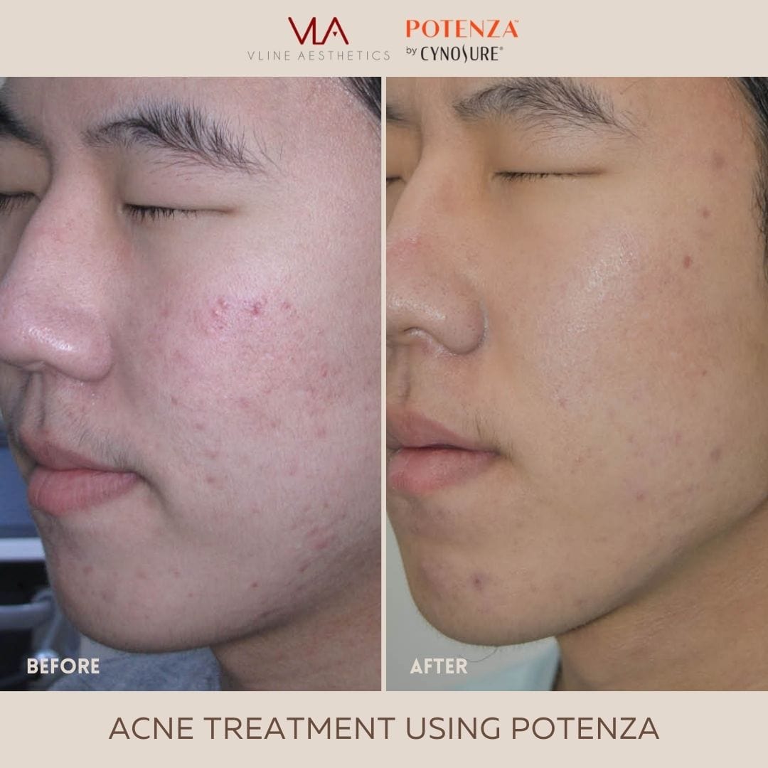 Potenza | RF Microneedling - Skin Perfect Brothers Powered by VLA