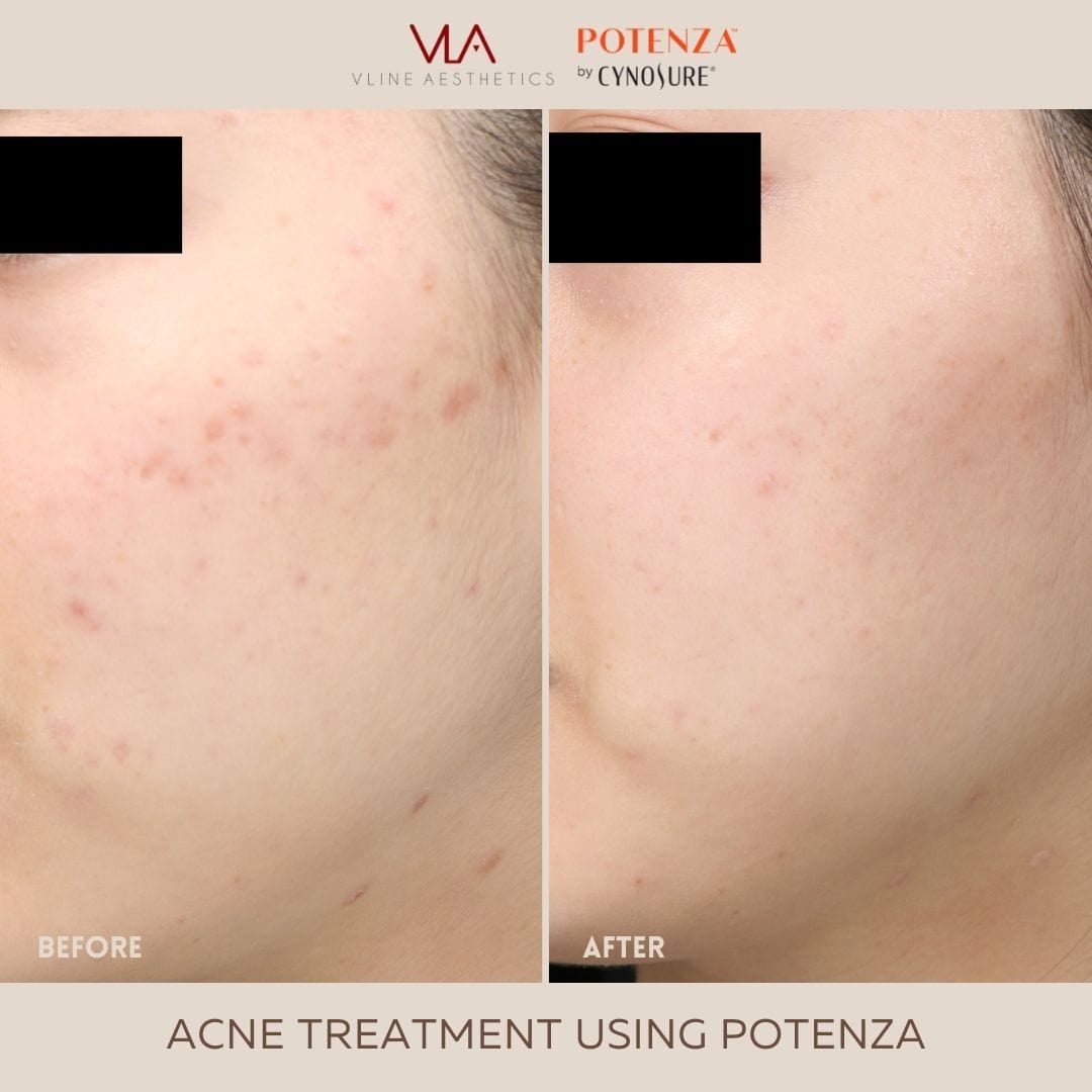 Potenza | RF Microneedling - Skin Perfect Brothers Powered by VLA