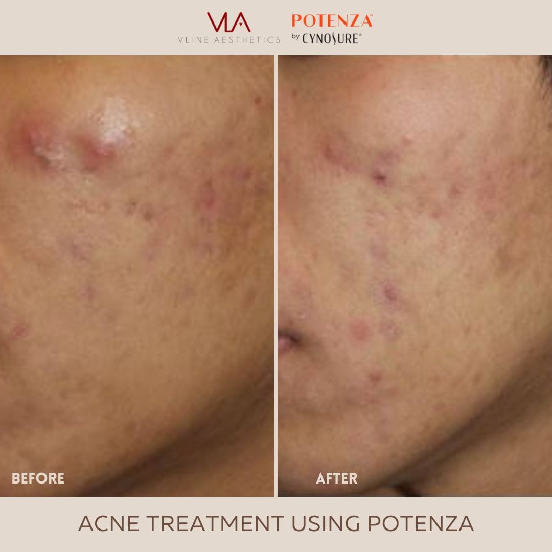 Potenza | RF Microneedling - Skin Perfect Brothers Powered by VLA