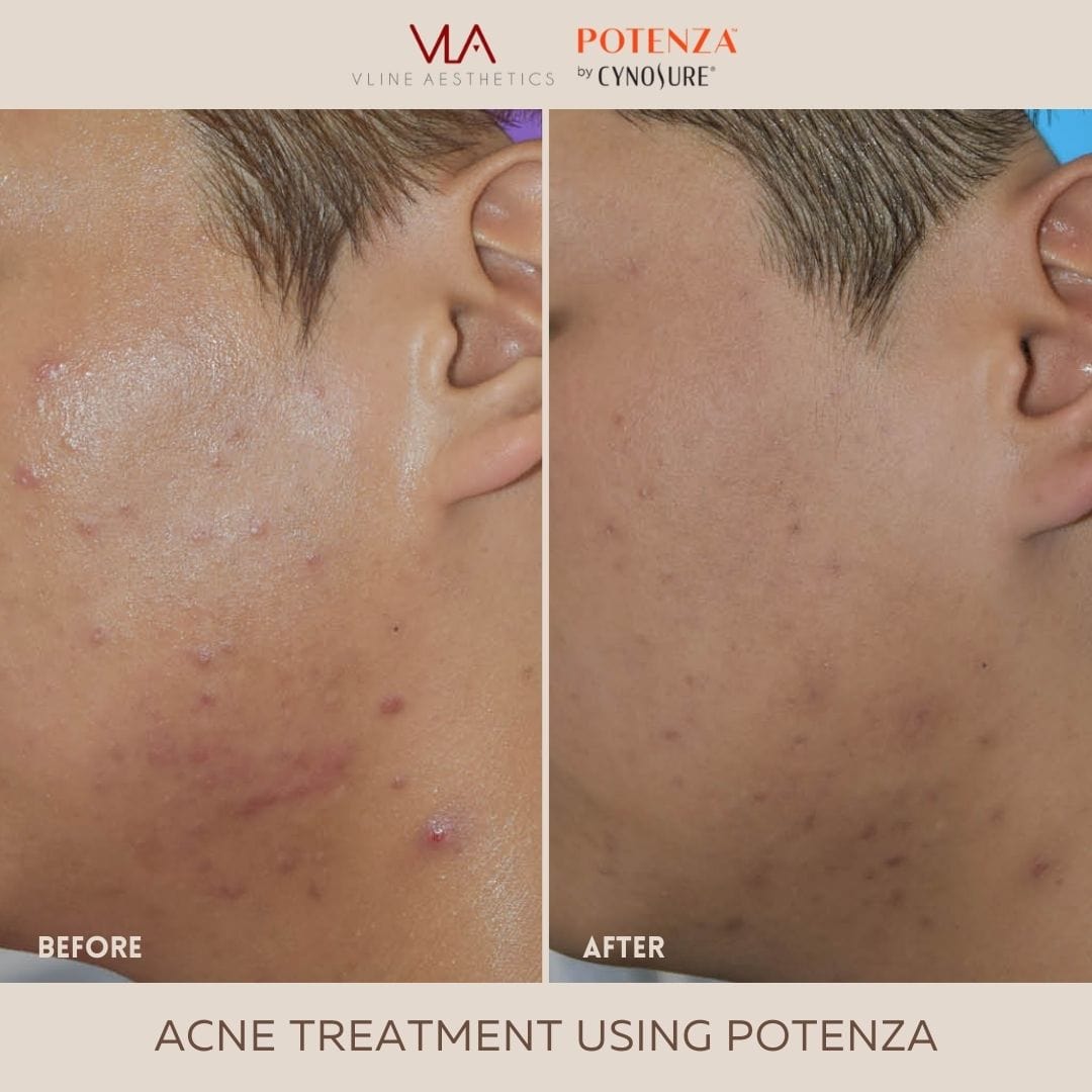 Potenza | RF Microneedling - Skin Perfect Brothers Powered by VLA