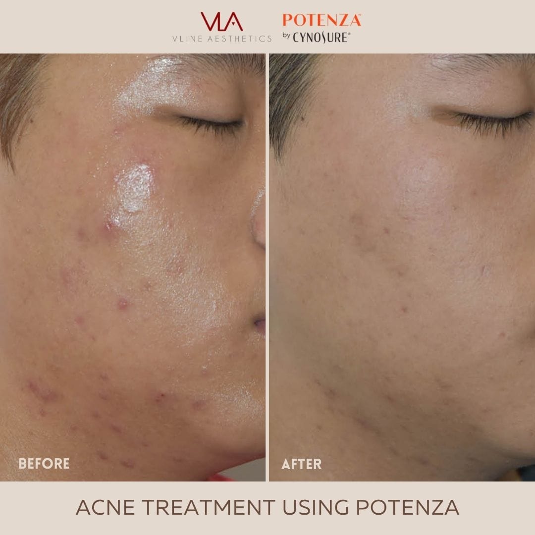 Potenza | RF Microneedling - Skin Perfect Brothers Powered by VLA