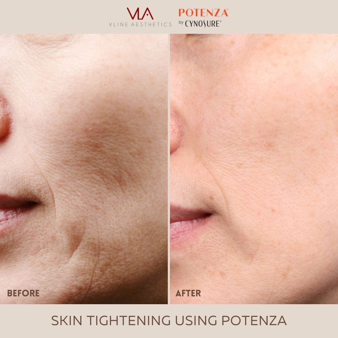 Potenza | RF Microneedling - Skin Perfect Brothers Powered by VLA