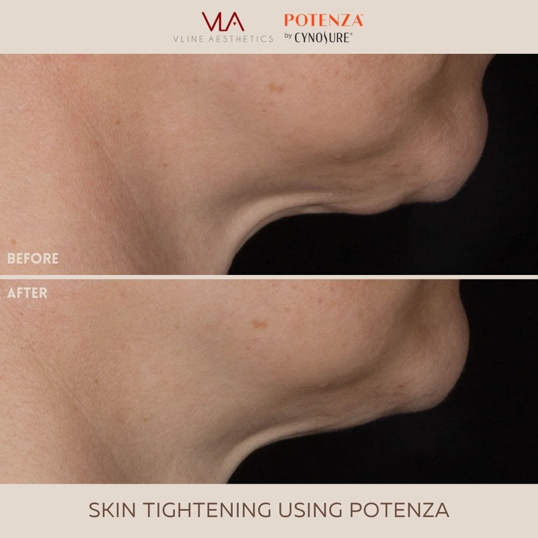 Potenza | RF Microneedling - Skin Perfect Brothers Powered by VLA