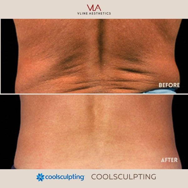 Coolsculpting | Body Sculpting - Skin Perfect Brothers Powered by VLA