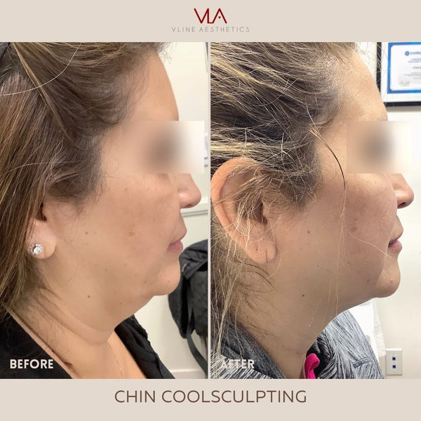 Coolsculpting | Body Sculpting - Skin Perfect Brothers Powered by VLA