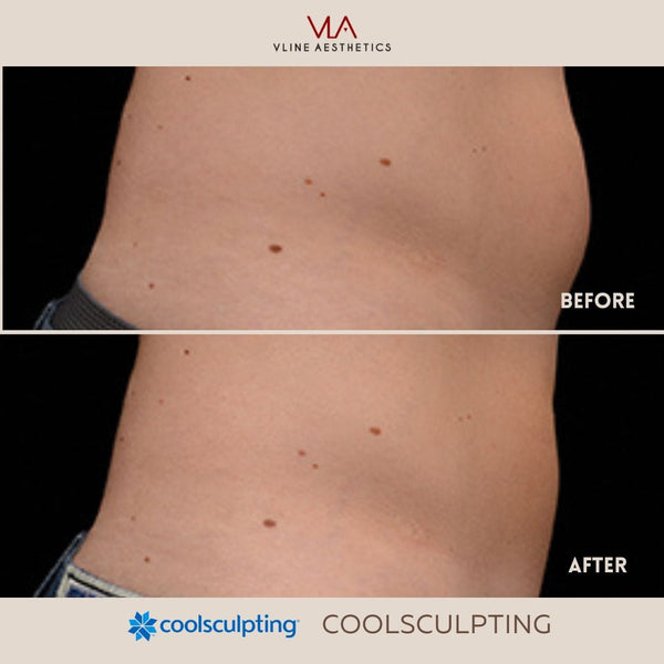 Coolsculpting | Body Sculpting - Skin Perfect Brothers Powered by VLA
