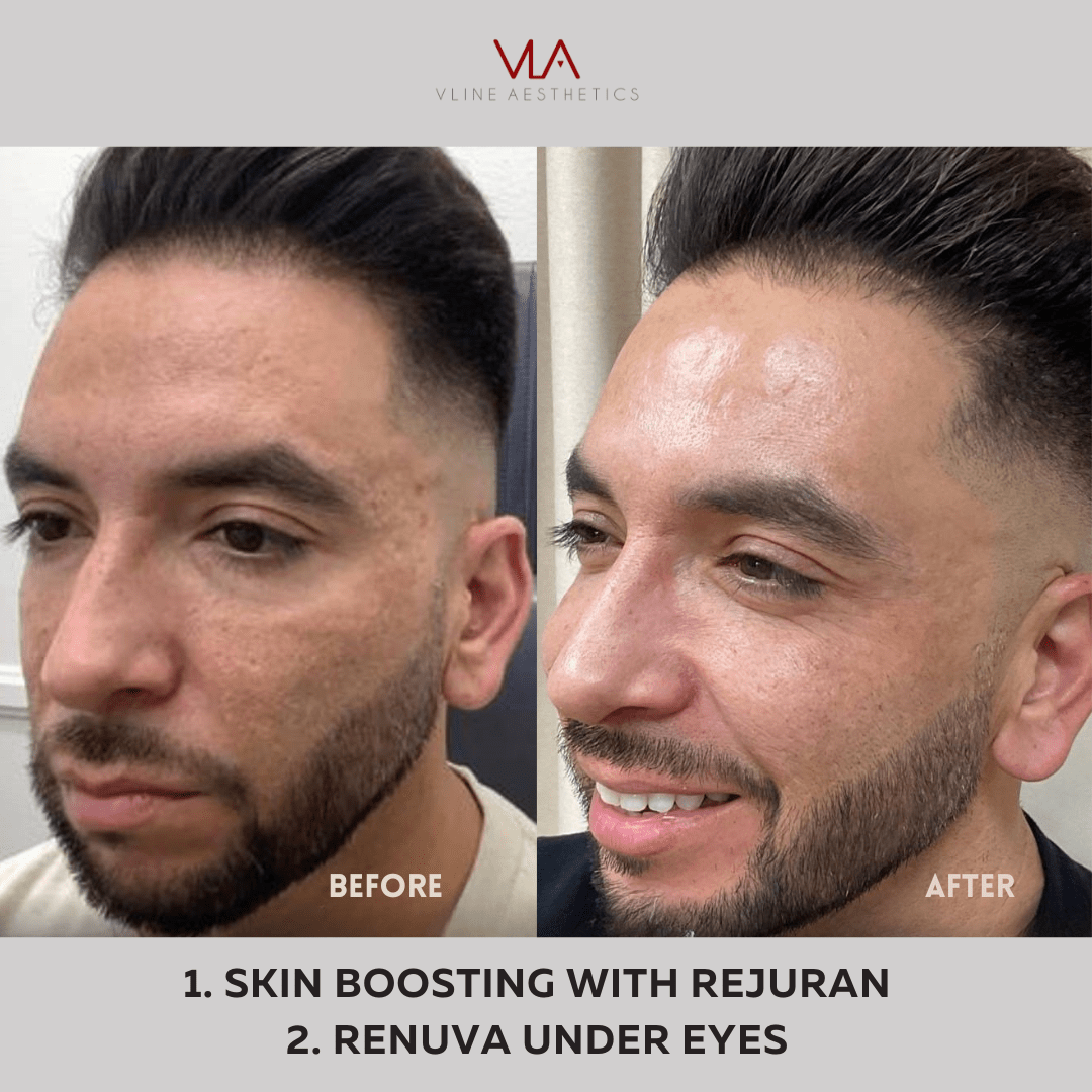 Skin Boosting Infusion - Skin Perfect Brothers Powered by VLA
