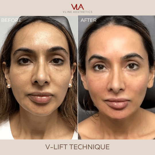 Injectable / V-Line Power Lift - Skin Perfect Brothers Powered by VLA