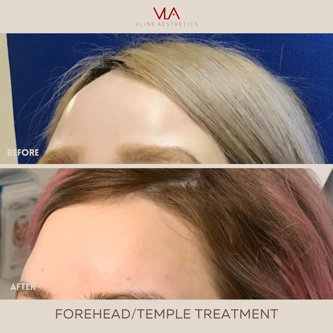 Temple Lift - Skin Perfect Brothers Powered by VLA