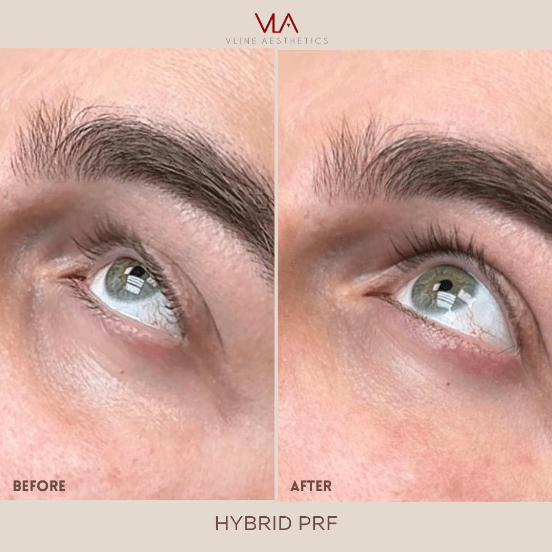 Vampire Eye Treatment - Platelet-Rich Fibrin (PRF) - Skin Perfect Brothers Powered by VLA