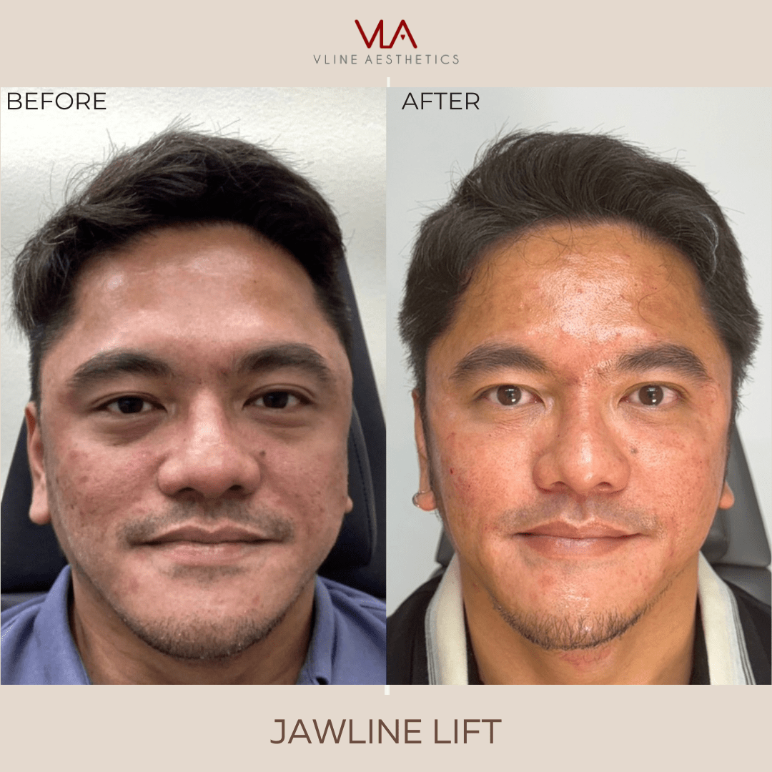 Collagen Lift - Skin Perfect Brothers Powered by VLA
