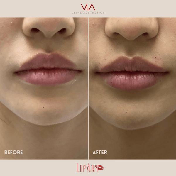 Lip Art - Skin Perfect Brothers Powered by VLA