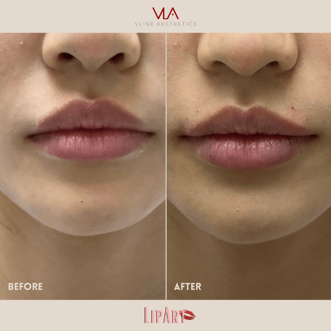 Lip Art - Skin Perfect Brothers Powered by VLA