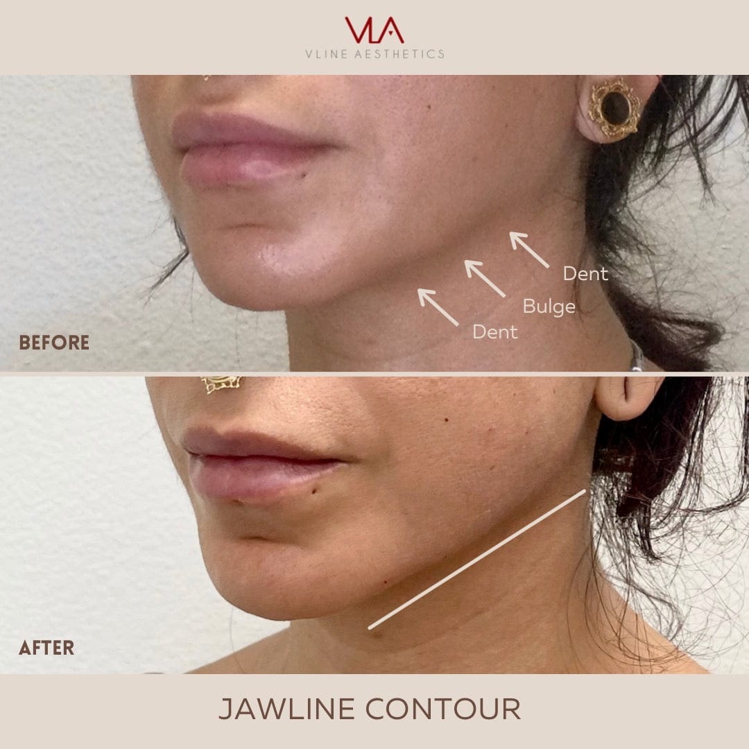 Juvéderm VOLUX XC - Skin Perfect Brothers Powered by VLA