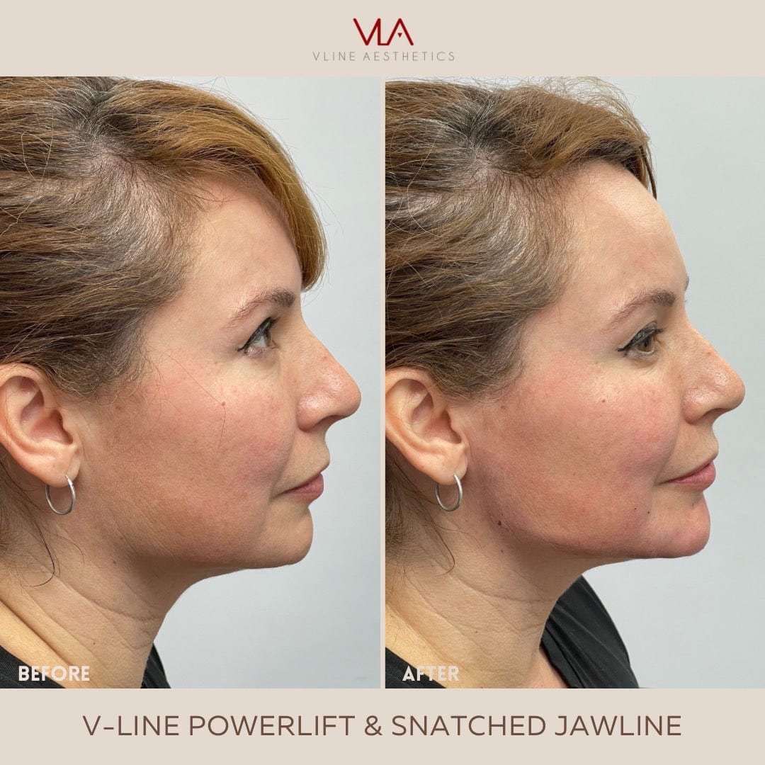 Juvéderm VOLUX XC - Skin Perfect Brothers Powered by VLA