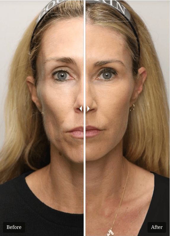 Renuva - Skin Perfect Brothers Powered by VLA