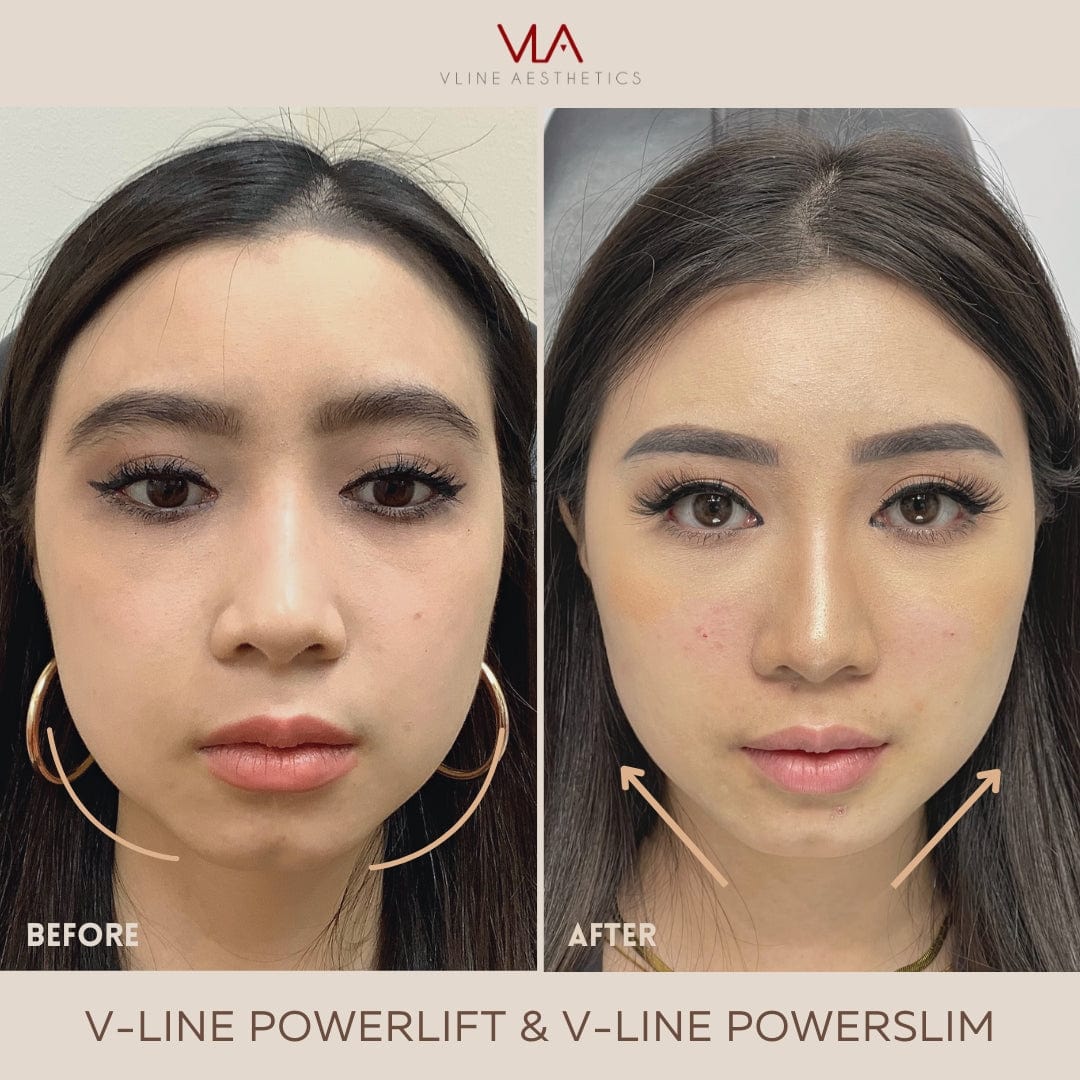 Collagen Lift - Skin Perfect Brothers Powered by VLA