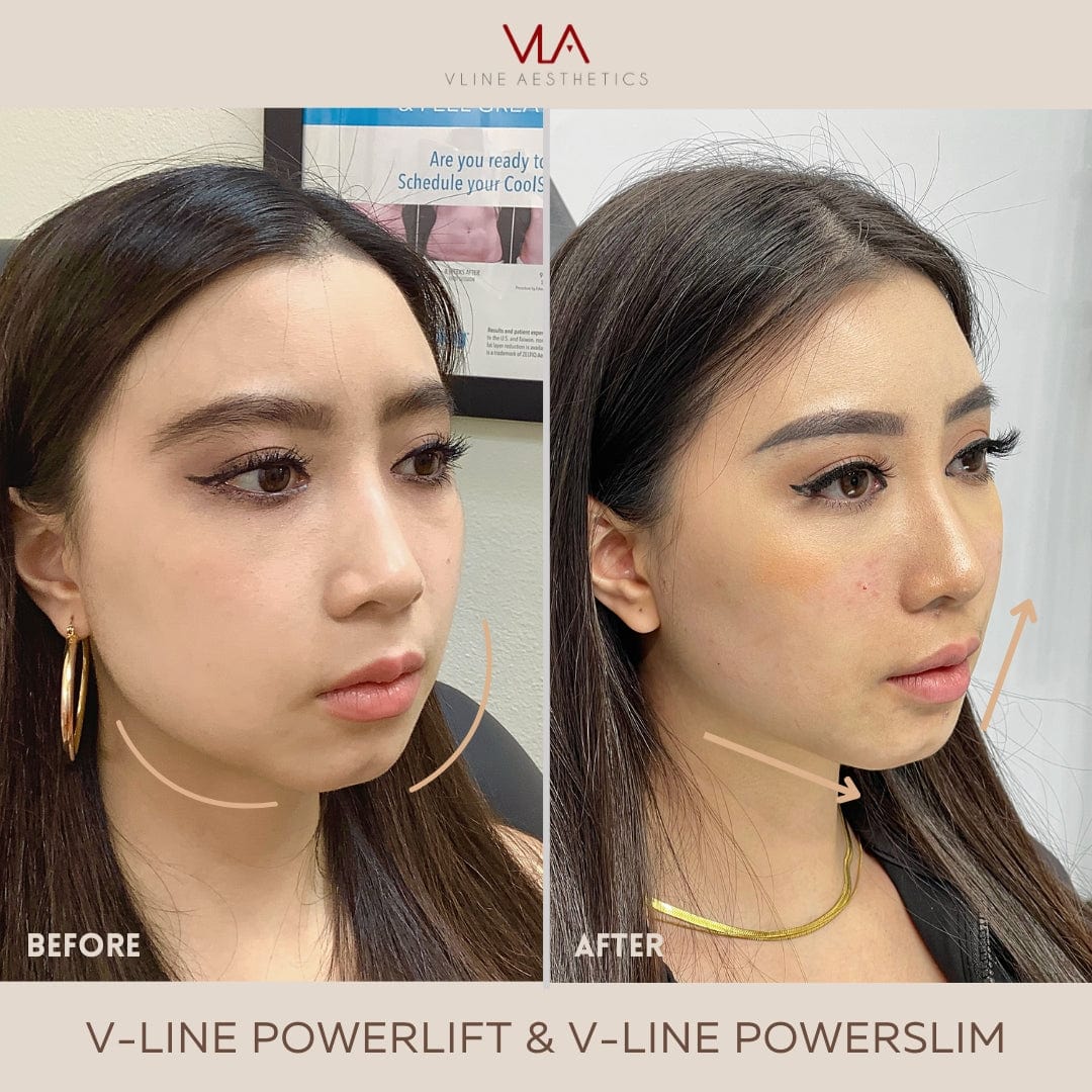 Collagen Lift - Skin Perfect Brothers Powered by VLA