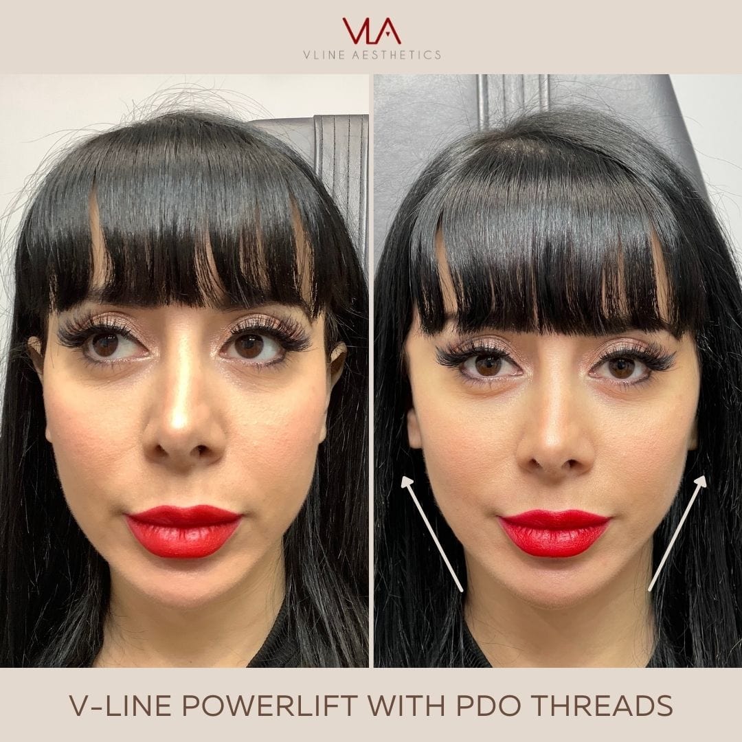 PDO Contour Threads - Buy 1 Get 1 Free - Skin Perfect Brothers Powered by VLA