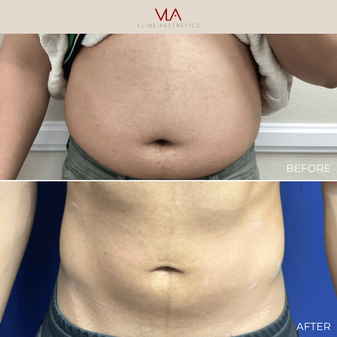 BMW Weight Loss Membership - Skin Perfect Brothers Powered by VLA
