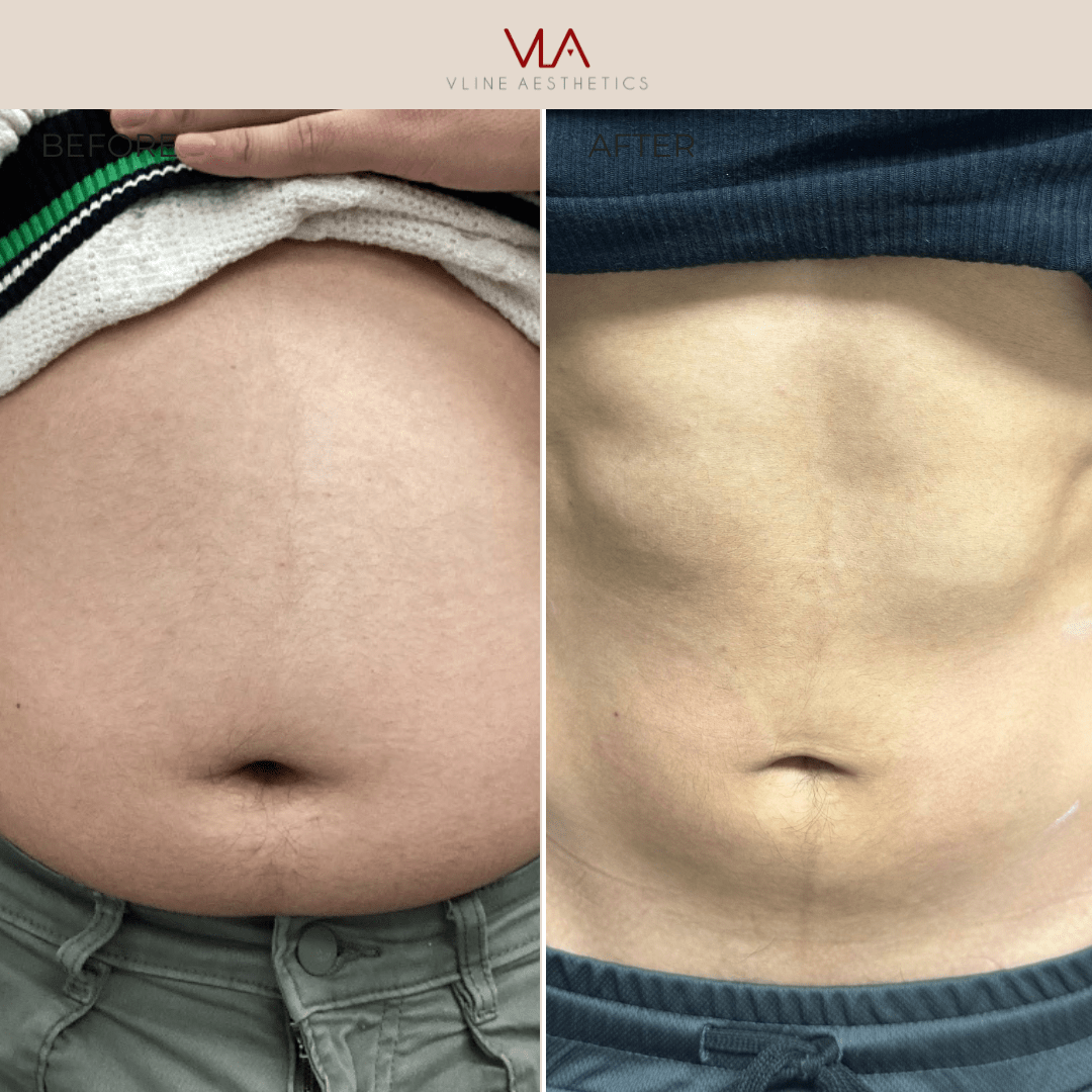 BMW Weight Loss Membership - Skin Perfect Brothers Powered by VLA