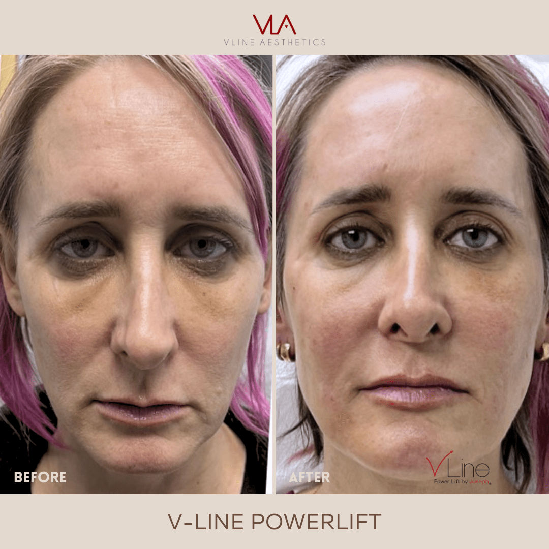 Collagen Lift - Skin Perfect Brothers Powered by VLA