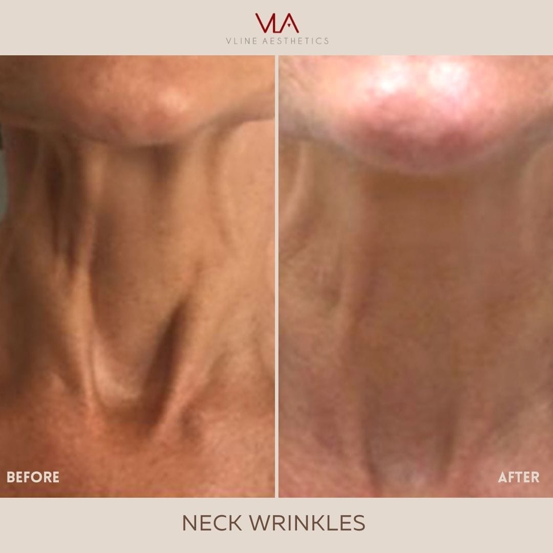 XEOMIN / JEUVEAU - Skin Perfect Brothers Powered by VLA